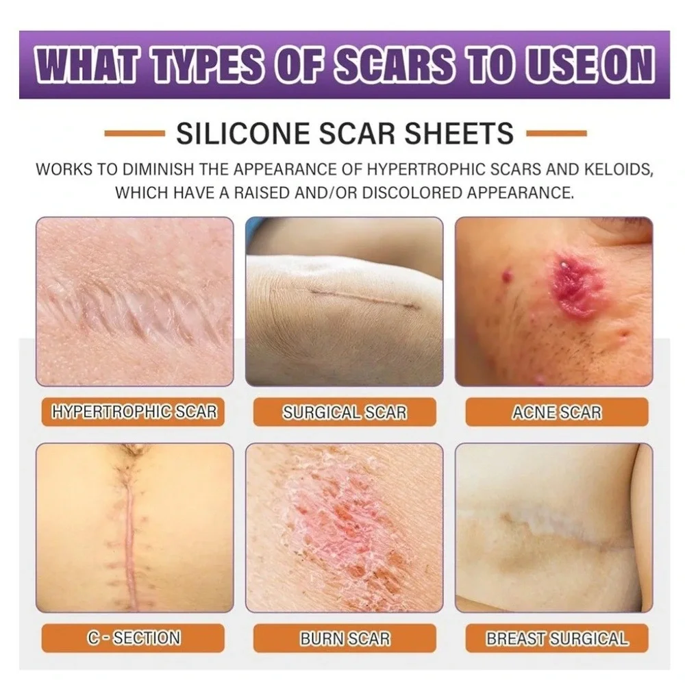 Silicone Scar Sheets,Silicone Scar Tape,Scar Tape For Surgical Scars,Silicone